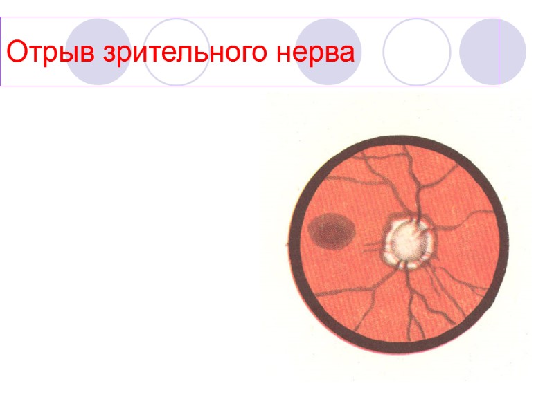 Отрыв зрительного нерва